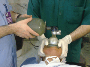 If you need to ventilate using a BVM the 2 person "Thenar Eminence Technique" (Thumbs-to-toes) is much more effective than single person or C-grip.